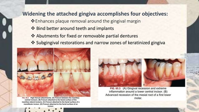 Free gingival graft PPT Free gingival graft PPT