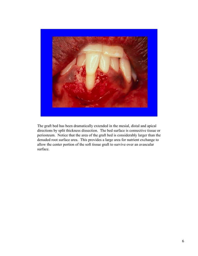 Free gingival grafts PDF