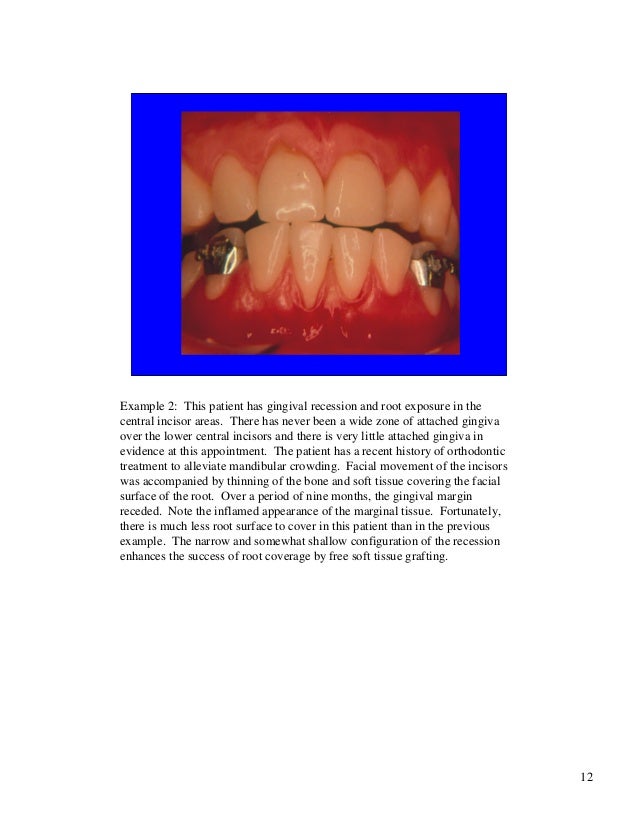 Free gingival grafts