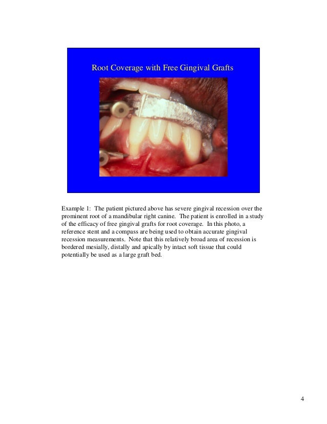 Free gingival grafts