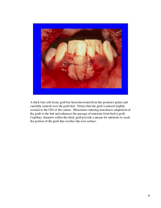 Free gingival grafts