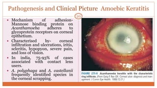 Pathogenesis and Clinical Picture Amoebic Keratitis
20
 Mechanism of adhesion-
Mannose binding protein on
Acanthamoeba adheres to
glycoprotein receptors on corneal
epithetium.
 Characterised by- corneal
infiltration and ulcerations, iritis,
scleritis, hypopyon, severe pain,
and loss of vision.
 In india, 75-93% of cases
associated with contact lens
users.
 A. polyphaga and A. castellanii
frequently identified species in
the corneal scrapping.
 