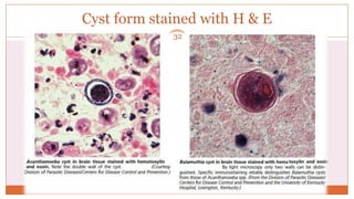 Cyst form stained with H & E
32
 