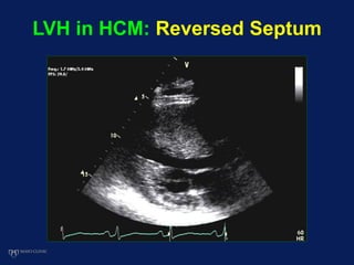 LVH in HCM: Reversed Septum
 