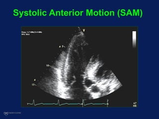 Systolic Anterior Motion (SAM)
 