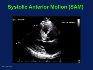 Systolic Anterior Motion (SAM)
 