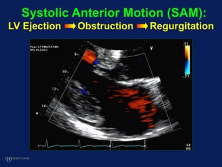 Systolic Anterior Motion (SAM):
LV Ejection Obstruction Regurgitation
 