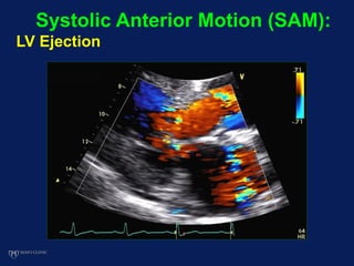 Systolic Anterior Motion (SAM):
LV Ejection
 