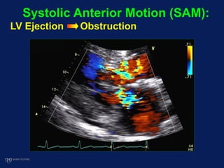 Systolic Anterior Motion (SAM):
LV Ejection Obstruction
 
