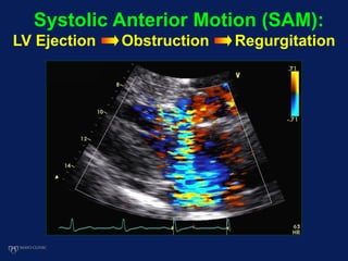 Systolic Anterior Motion (SAM):
LV Ejection Obstruction Regurgitation
 