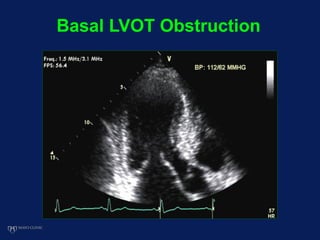 Basal LVOT Obstruction
 