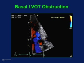 Basal LVOT Obstruction
 