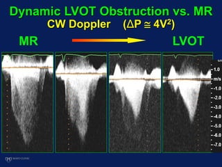 MR LVOT
Dynamic LVOT Obstruction vs. MR
CW Doppler (ΔP  4V2)
 