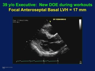 39 y/o Executive: New DOE during workouts
Focal Anteroseptal Basal LVH = 17 mm
 