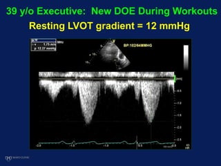 39 y/o Executive: New DOE During Workouts
Resting LVOT gradient = 12 mmHg
 