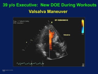 39 y/o Executive: New DOE During Workouts
Valsalva Maneuver
 