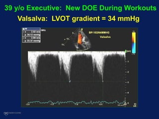 39 y/o Executive: New DOE During Workouts
Valsalva: LVOT gradient = 34 mmHg
 