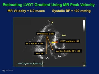 LAP  15
P  4 (6.9)2 = 190
LV Pressure  205
Aortic  Systolic BP = 100
LV
Ao
LA
LVOT gradient  105
Estimating LVOT Gradient Using MR Peak Velocity
MR Velocity = 6.9 m/sec Systolic BP = 100 mmHg
 