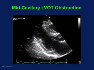 Mid-Cavitary LVOT Obstruction
 