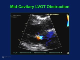 Mid-Cavitary LVOT Obstruction
 