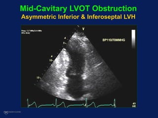 Mid-Cavitary LVOT Obstruction
Asymmetric Inferior & Inferoseptal LVH
 