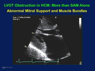 LVOT Obstruction in HCM: More than SAM Alone
Abnormal Mitral Support and Muscle Bundles
 