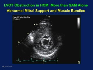 LVOT Obstruction in HCM: More than SAM Alone
Abnormal Mitral Support and Muscle Bundles
 