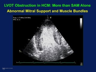 LVOT Obstruction in HCM: More than SAM Alone
Abnormal Mitral Support and Muscle Bundles
 