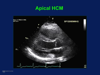Apical HCM
 