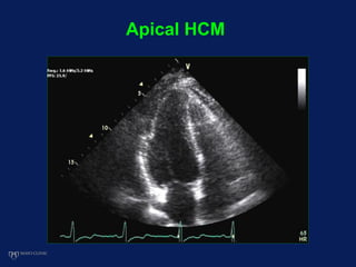 Apical HCM
 
