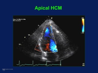 Apical HCM
 