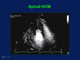Apical HCM
 