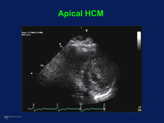 Apical HCM
 