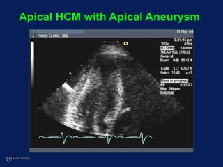 Apical HCM with Apical Aneurysm
 