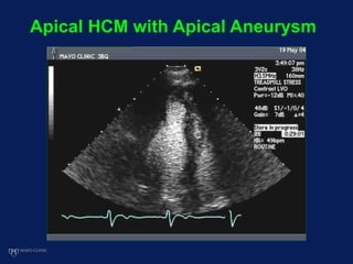 Apical HCM with Apical Aneurysm
 