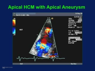 Apical HCM with Apical Aneurysm
 
