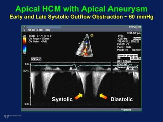 Apical HCM with Apical Aneurysm
Early and Late Systolic Outflow Obstruction ~ 60 mmHg
Systolic Diastolic
 
