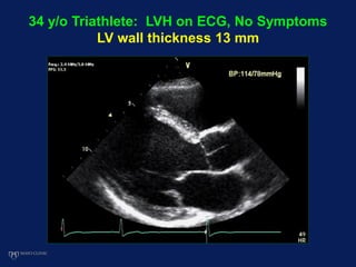 34 y/o Triathlete: LVH on ECG, No Symptoms
LV wall thickness 13 mm
 