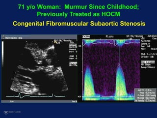 71 y/o Woman: Murmur Since Childhood;
Previously Treated as HOCM
Congenital Fibromuscular Subaortic Stenosis
 