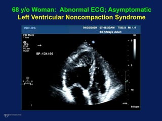 68 y/o Woman: Abnormal ECG; Asymptomatic
Left Ventricular Noncompaction Syndrome
 