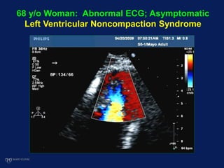 68 y/o Woman: Abnormal ECG; Asymptomatic
Left Ventricular Noncompaction Syndrome
 
