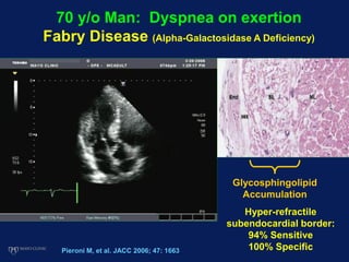 70 y/o Man: Dyspnea on exertion
Fabry Disease (Alpha-Galactosidase A Deficiency)
Glycosphingolipid
Accumulation
Pieroni M, et al. JACC 2006; 47: 1663
Hyper-refractile
subendocardial border:
94% Sensitive
100% Specific
 