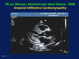 56 y/o Woman: Biventricular heart failure; SAM
Amyloid Infiltrative Cardiomyopathy
 