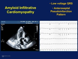 Amyloid Infiltrative
Cardiomyopathy
• Low voltage QRS
• Anteroseptal
Pseudoinfarction
Pattern
 