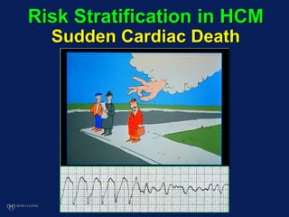 Risk Stratification in HCM
Sudden Cardiac Death
 