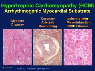 Hypertrophic Cardiomyopathy (HCM)
Arrhythmogenic Myocardial Substrate
Myocyte
Disarray
Coronary
Arteriole
Remodeling
Ischemia
Micro-infarction
Fibrosis
Maron BJ. Circulation 2010; 121: 445
 
