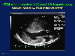 HCM with massive (>30 mm) LV hypertrophy
Septum: 42 mm; LV mass index 548 gm/m2
 