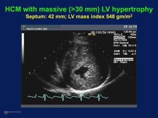 HCM with massive (>30 mm) LV hypertrophy
Septum: 42 mm; LV mass index 548 gm/m2
 