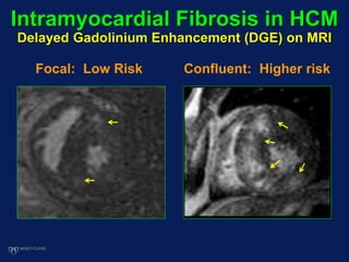 Intramyocardial Fibrosis in HCM
Delayed Gadolinium Enhancement (DGE) on MRI
Focal: Low Risk Confluent: Higher risk
 