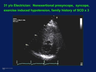 31 y/o Electrician: Nonexertional presyncope, syncope,
exercise induced hypotension, family history of SCD x 3
 